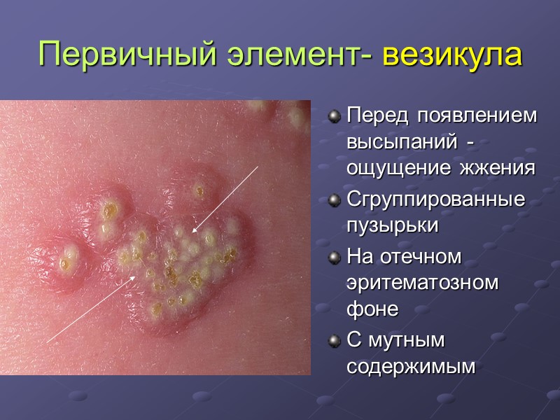Первичный элемент- везикула Перед появлением высыпаний - ощущение жжения Сгруппированные пузырьки На отечном эритематозном
